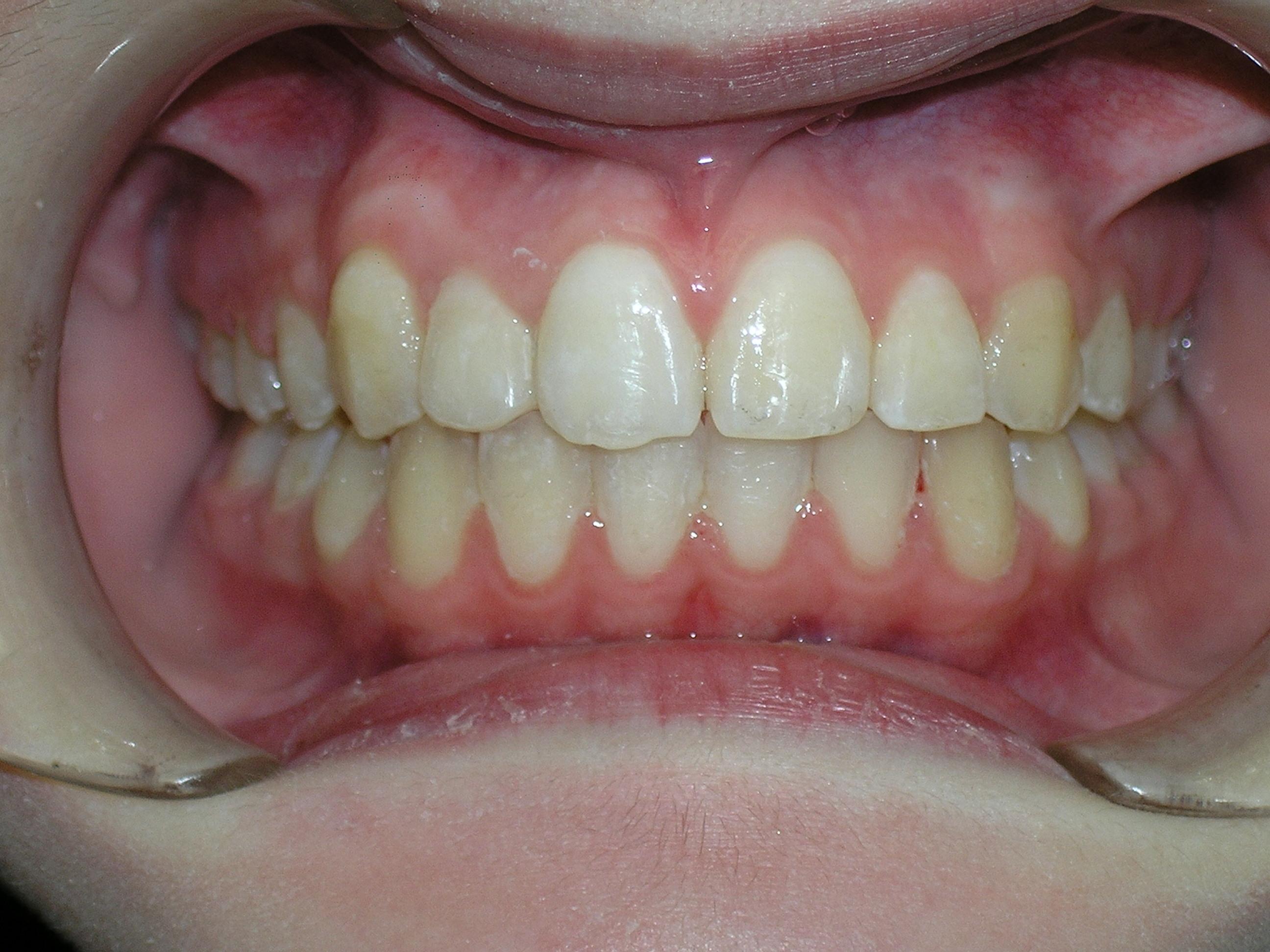 After treatment of underbite