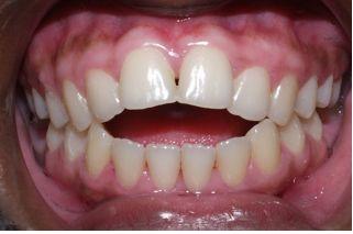Before treatment With underbite Teeth Image