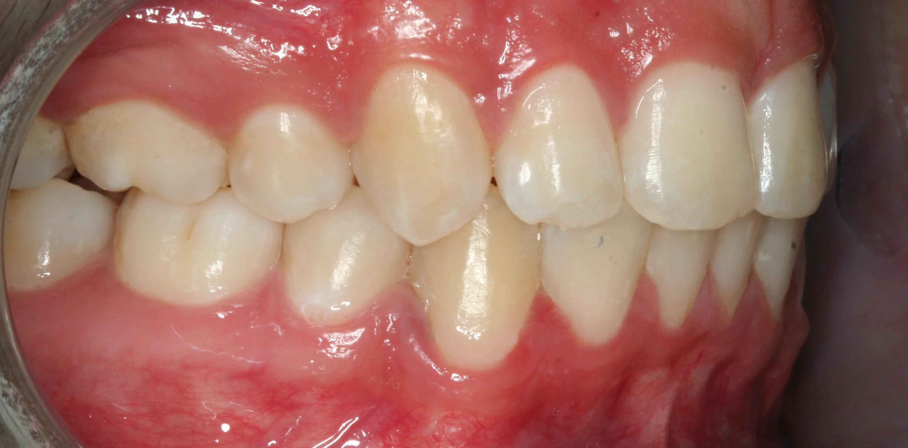 After treatment of underbite