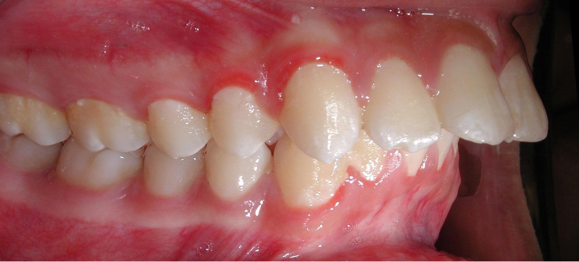 Before treatment With underbite Teeth Image